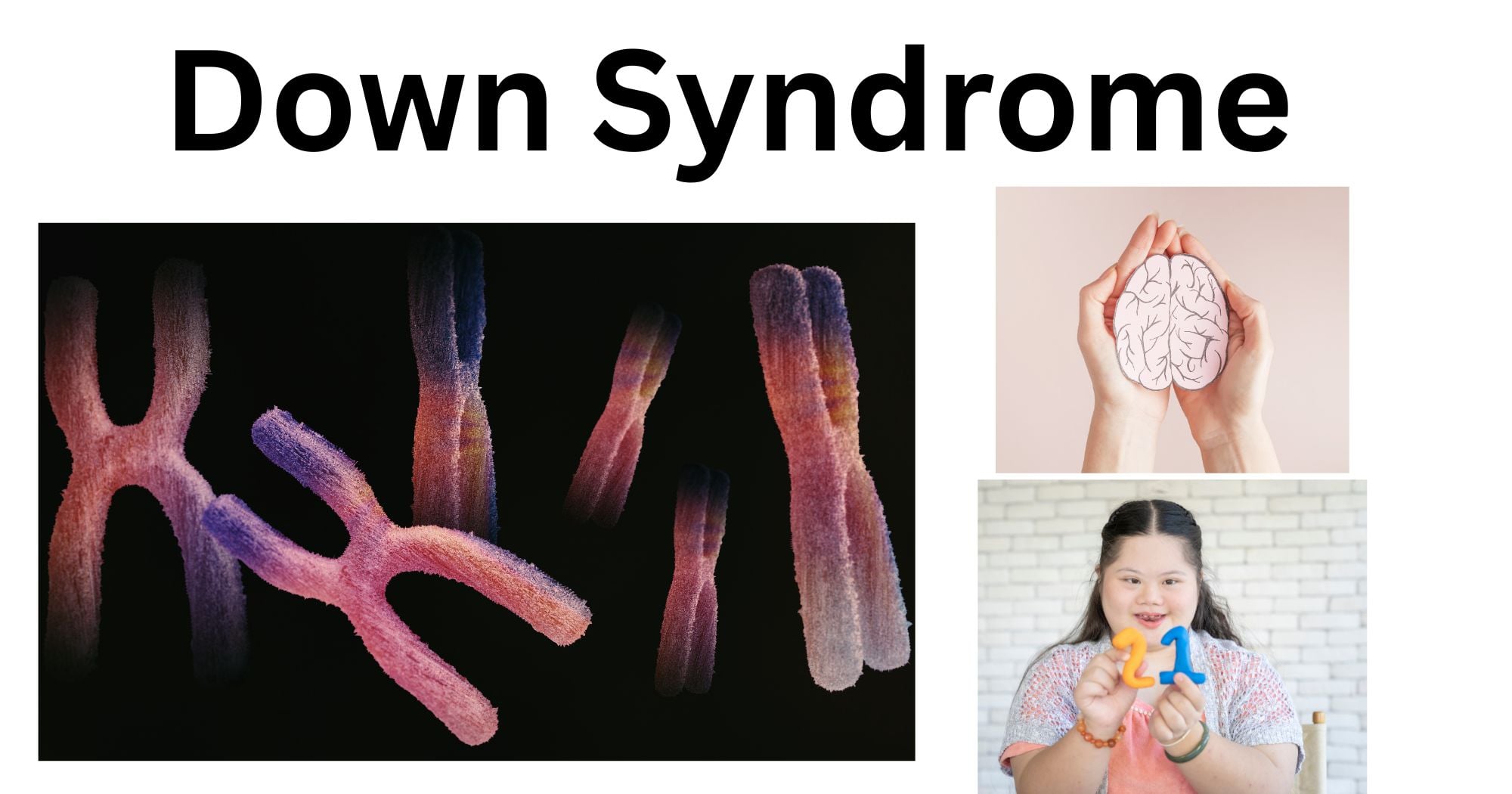 Down Syndrome Down Syndrome