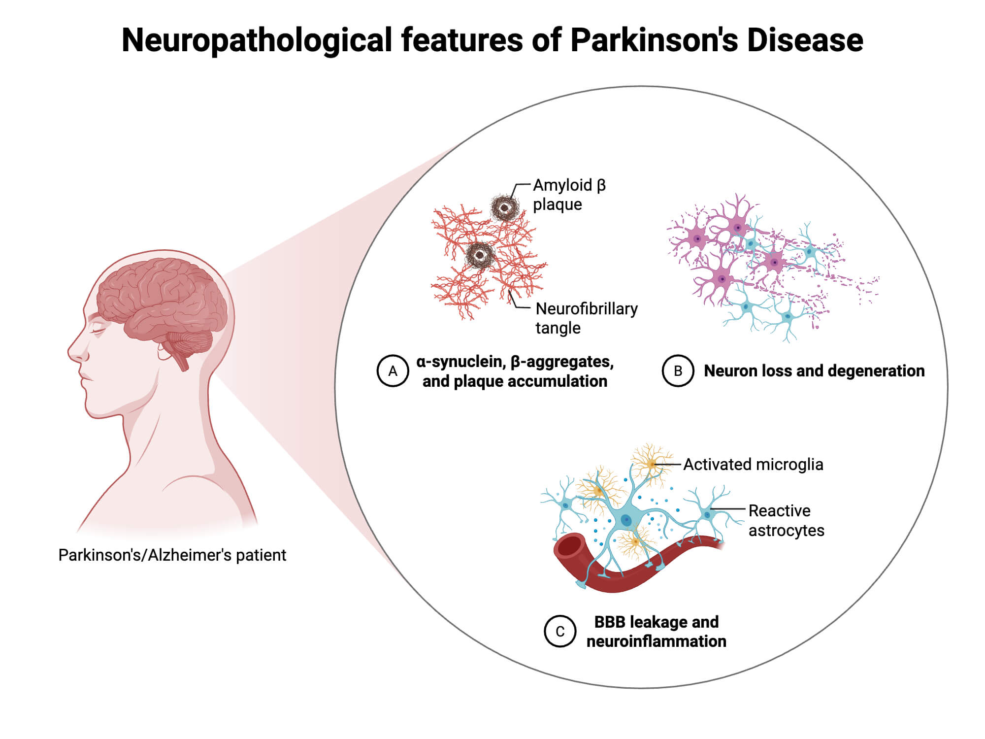 Neuropathological features of Parkinsons Disease Neuropathological features of Parkinson's Disease