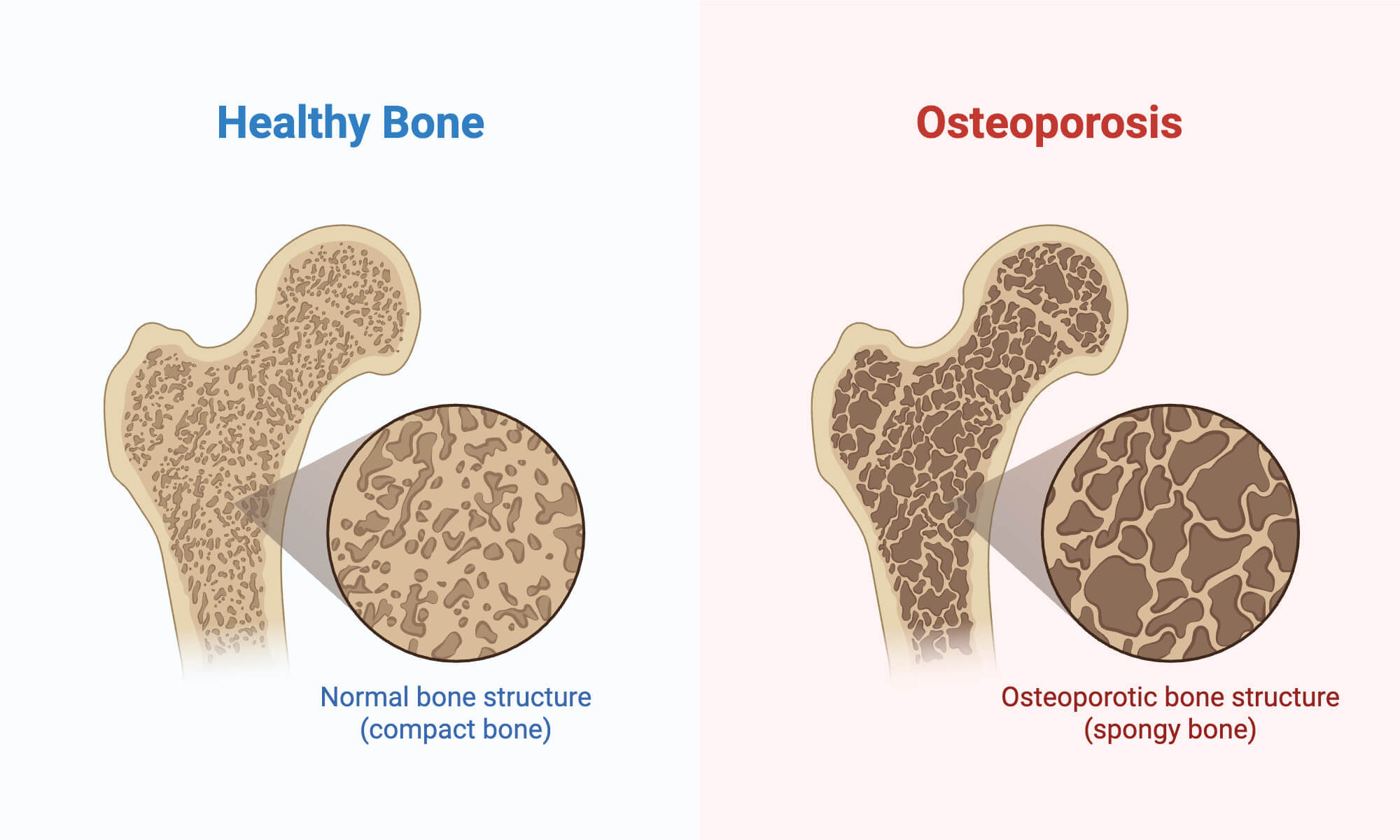 Osteoporosis Osteoporosis