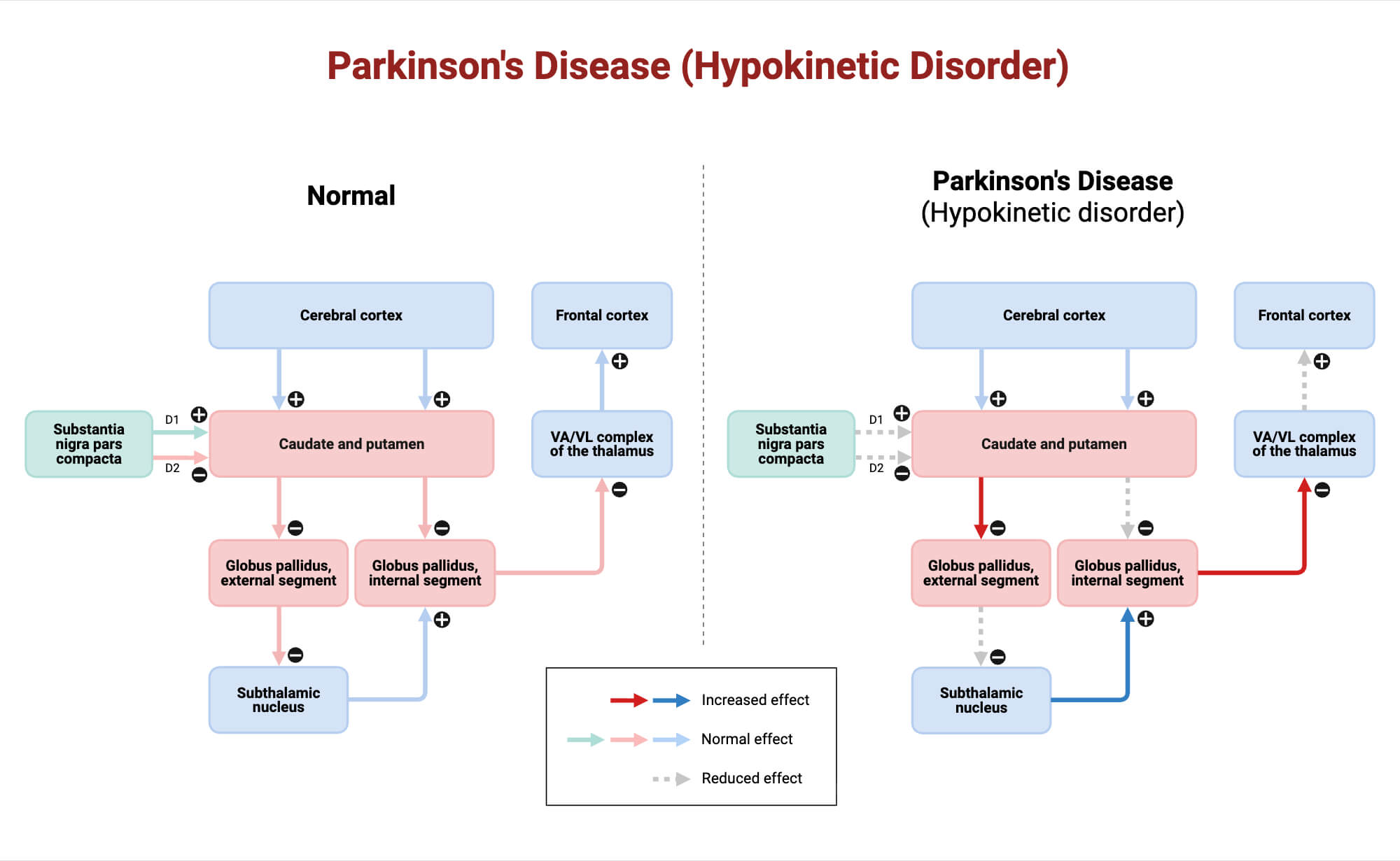 Parkinsons Disease Hypokinetic Disorder Parkinson's Disease (Hypokinetic Disorder)