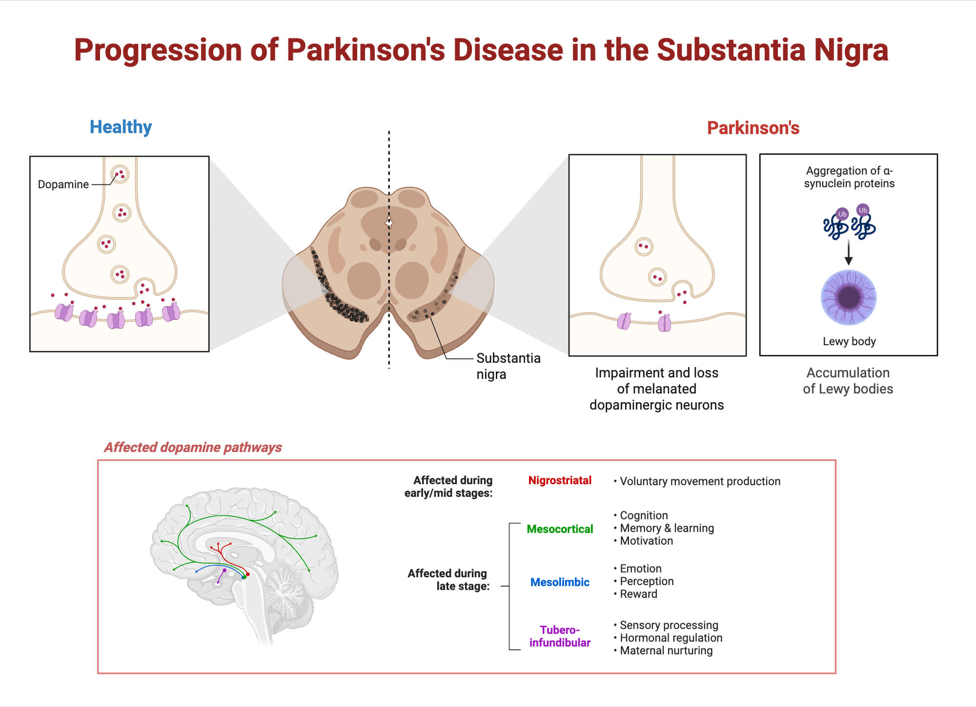 Progression of Parkinsons Disease in the Substantia Nigra Progression of Parkinson's Disease in the Substantia Nigra