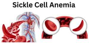 Sickle Cell Anemia Sickle Cell Anemia