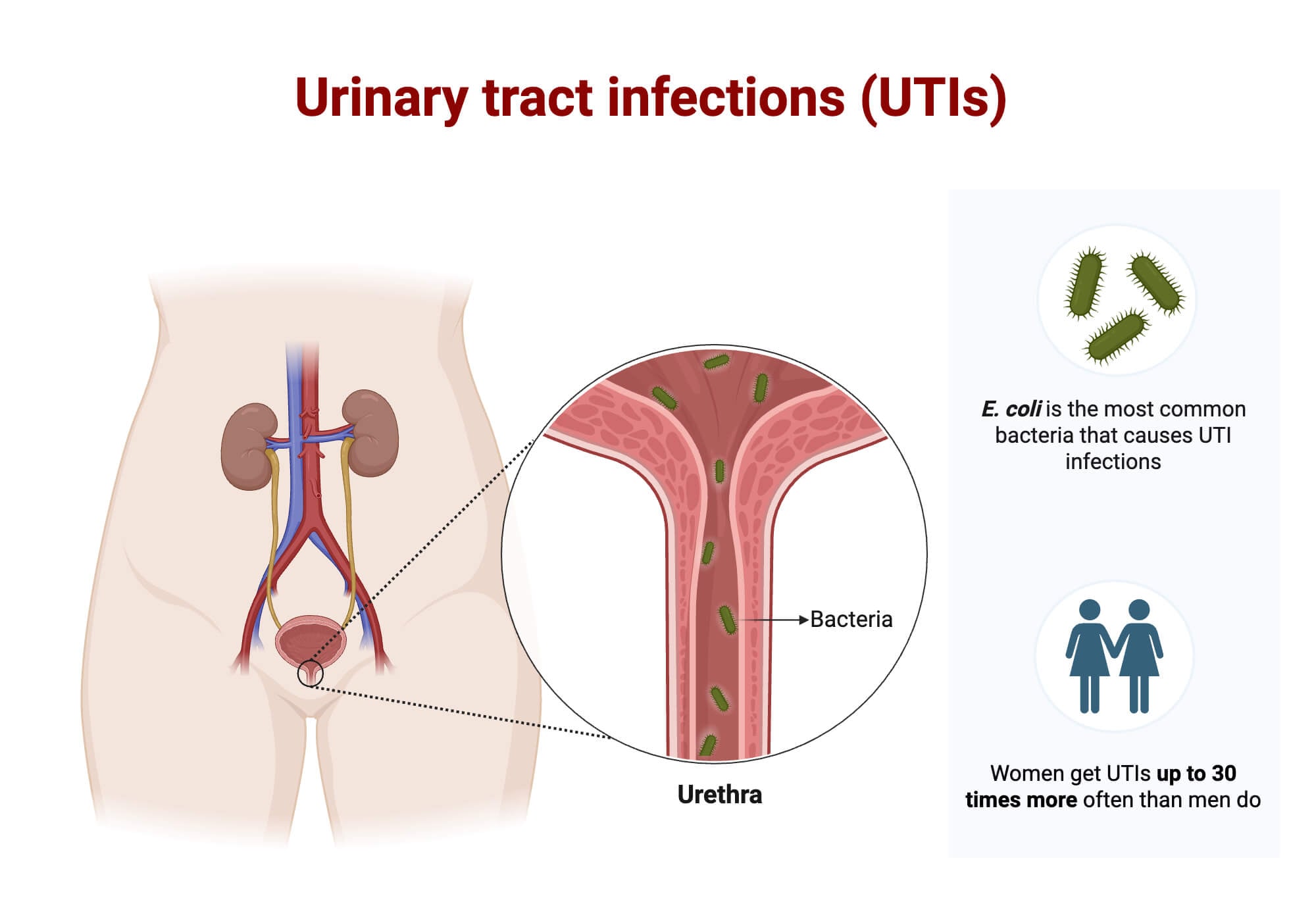 Urinary Tract Infections UTI Urinary Tract Infections (UTI)