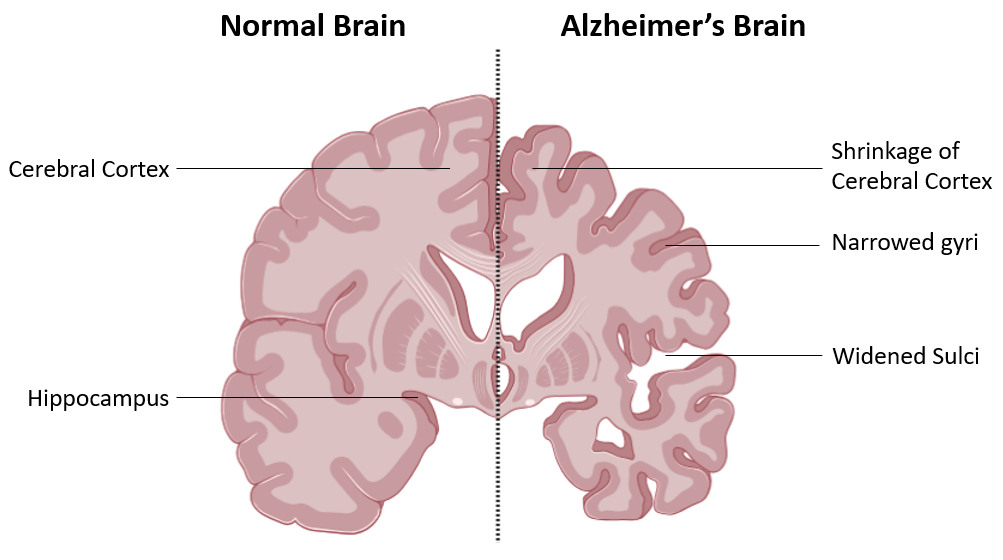image 176 Comparison of a normal brain and an Alzheimer's brain