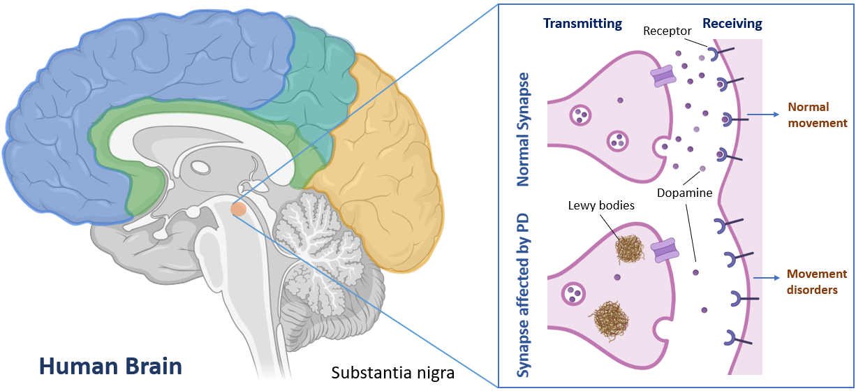 image 180 Loss of Dopamine Levels in Parkinson's Disease