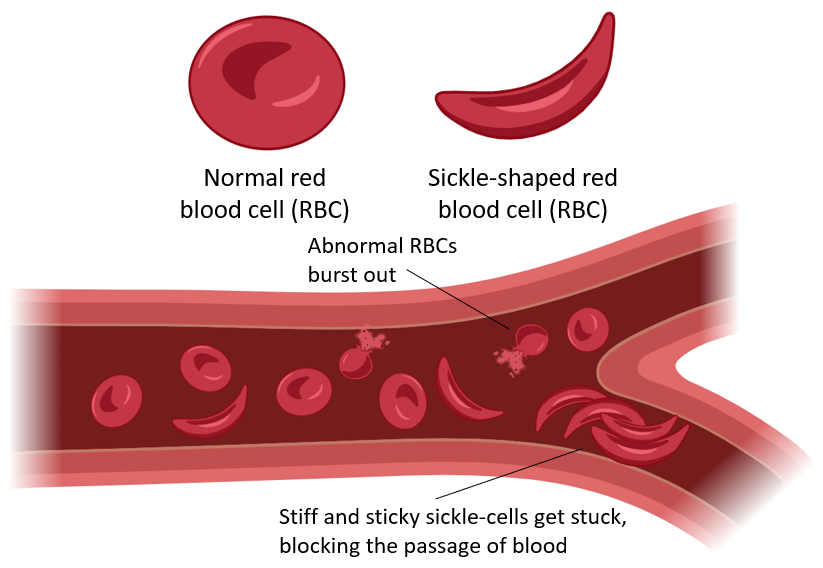 image 184
Blood flow through blood vessels in Sickle cell anemia