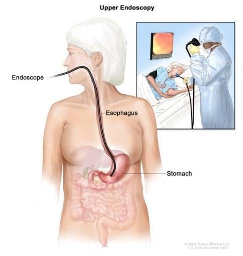image 49 Upper endoscopy