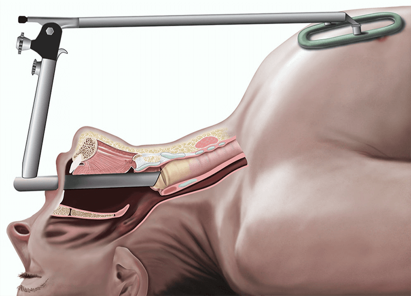 image 59 Laryngoscopy (Endoscopy)