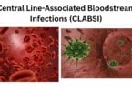 Central Line Associated Bloodstream Infections CLABSI Central Line-Associated Bloodstream Infections (CLABSI)