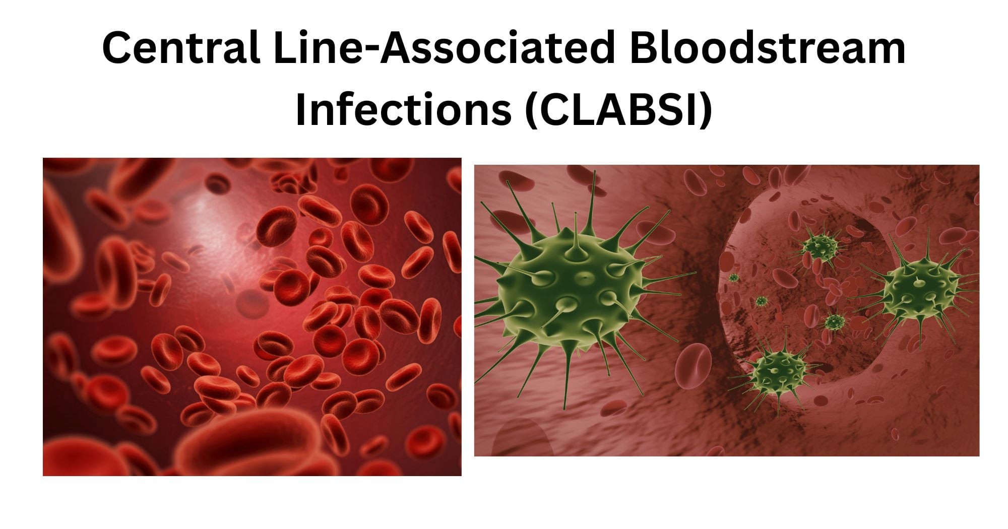 Central Line Associated Bloodstream Infections CLABSI Central line-associated bloodstream infection (CLABSI)