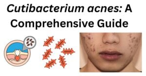 Cutibacterium acnes Cutibacterium acnes