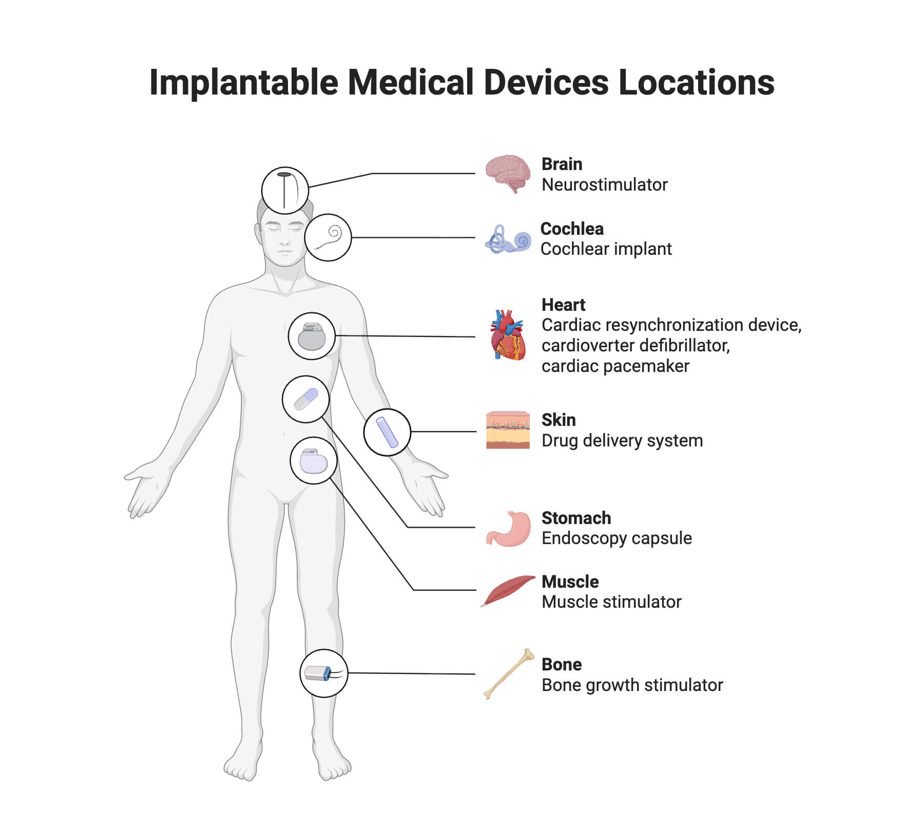 Implantable Medical Devices Locations Implantable Medical Devices Locations