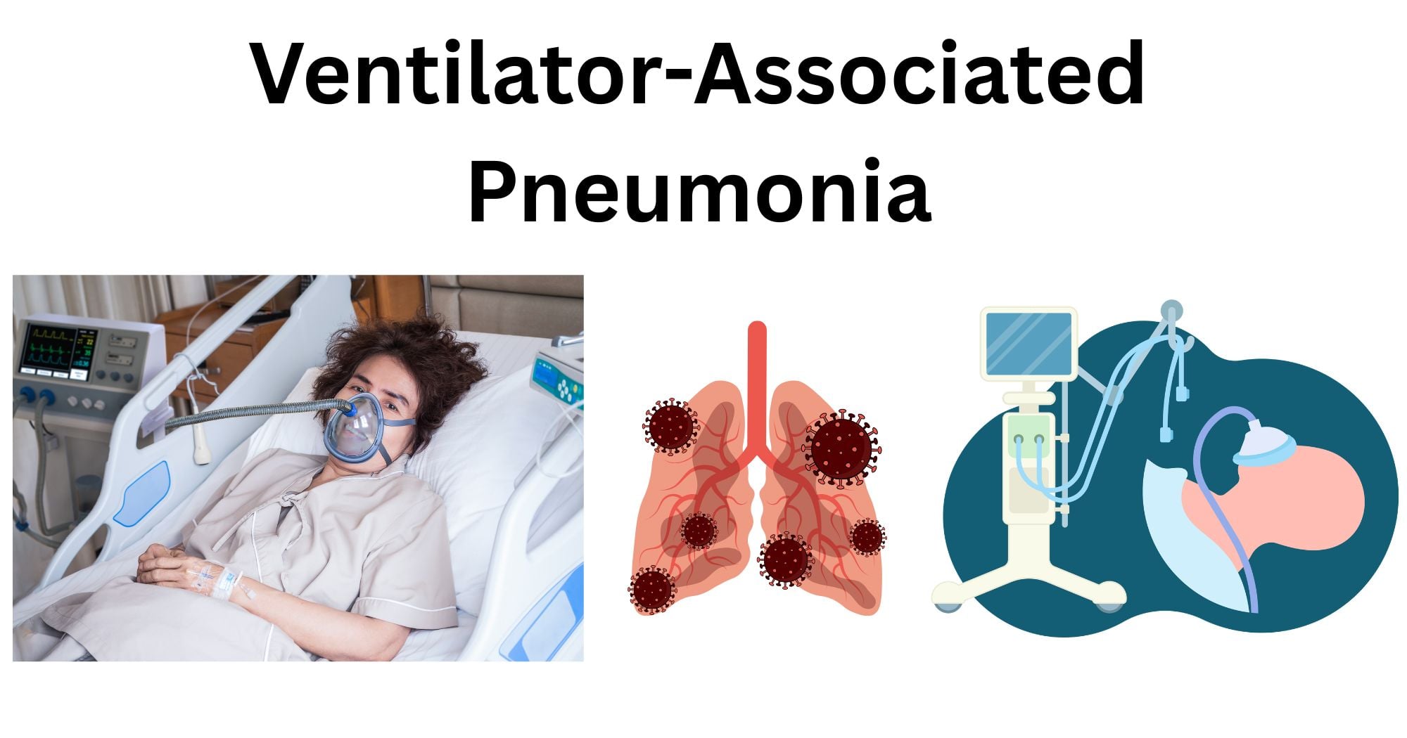 Ventilator-Associated Pneumonia (VAP)