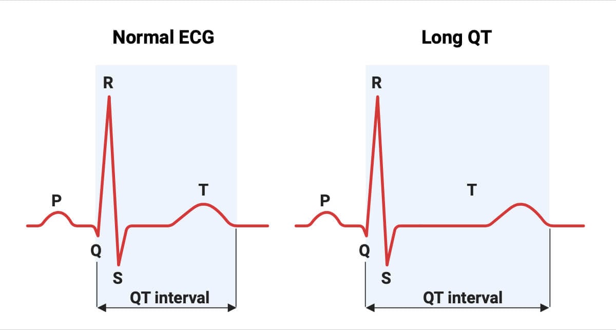 Long QT ECG Machine Long QT-ECG Machine